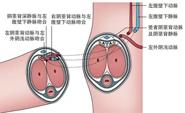 《柳葉刀》報(bào)告：三年前接受下體移植的男性已恢復(fù)正常功能  