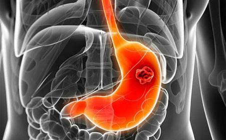 海外醫(yī)療，80%的患者檢查確診為胃癌中晚期，十類(lèi)人需警惕胃癌