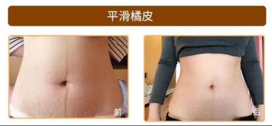 愛博恩醫(yī)學(xué)護理·引領(lǐng)產(chǎn)婦瘦身新浪潮