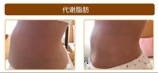 愛博恩醫(yī)學(xué)護理·引領(lǐng)產(chǎn)婦瘦身新浪潮