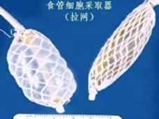 中國學(xué)者研發(fā)食管癌篩查新方法 “膠囊”采集細(xì)胞助患者早診早治