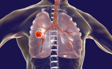 國家疾控局：全國結(jié)核病成功治療率保持在90%以上