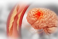 腦血管病藥械研發(fā)北京市重點實驗室成立