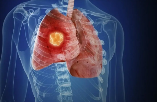 肺癌連續(xù)十年位居全球癌癥死亡率首位