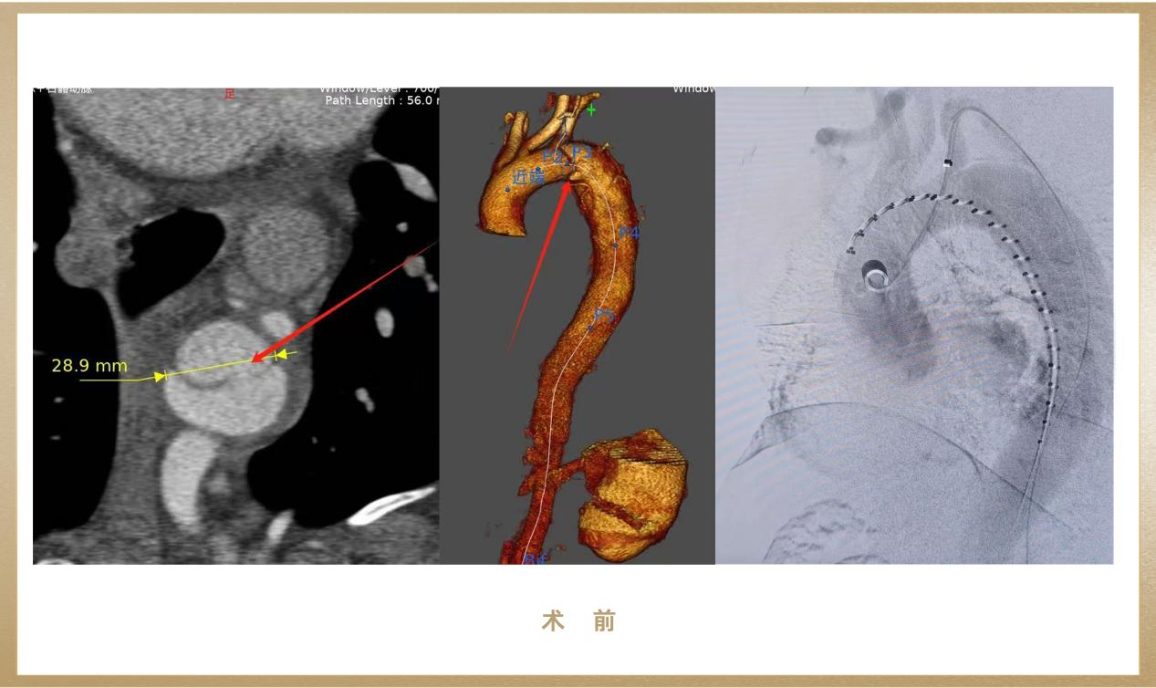 世界屋脊上的生命新高度！先健助力西藏阿里首例原位開窗胸主動(dòng)脈腔內(nèi)隔絕術(shù)
