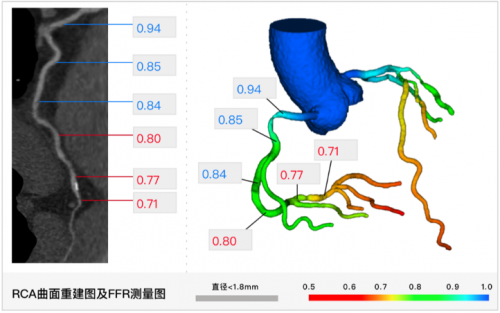 心臟的血管堵了，一定需要放支架嗎？